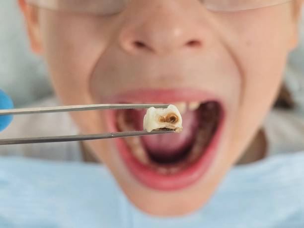 Best Emergency Wisdom Teeth Removal in Ata, OK